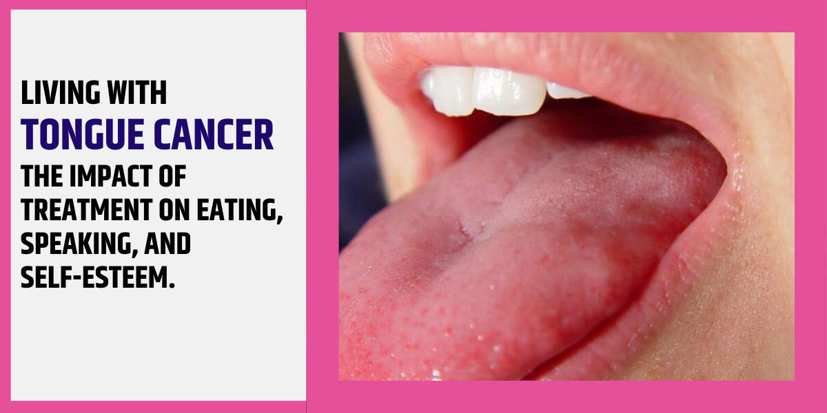 Living with Tongue Cancer: The Impact and of Treatment on Eating, Speaking, and Self-Esteem.