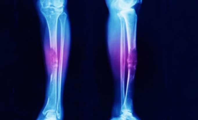 Bone and Soft Tissue cancer