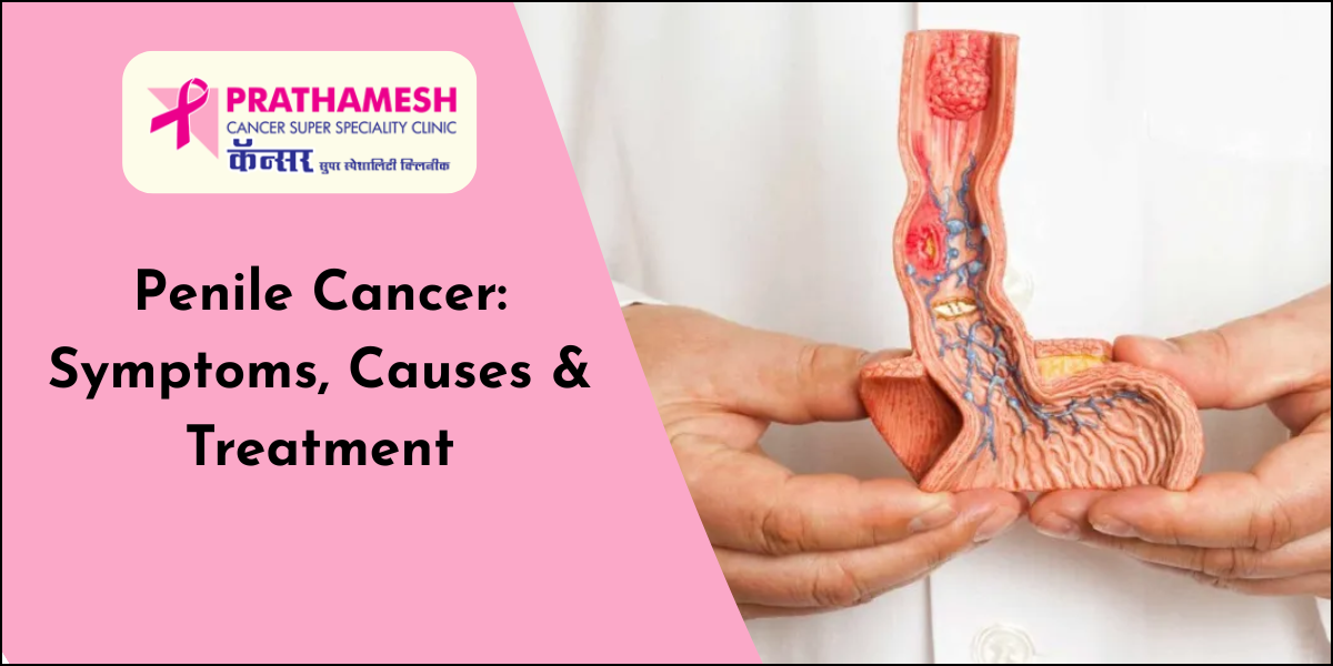 Penile Cancer Treatment in Pimpri Chinchwad (PCMC) – Dr. Ashish Pokharkar