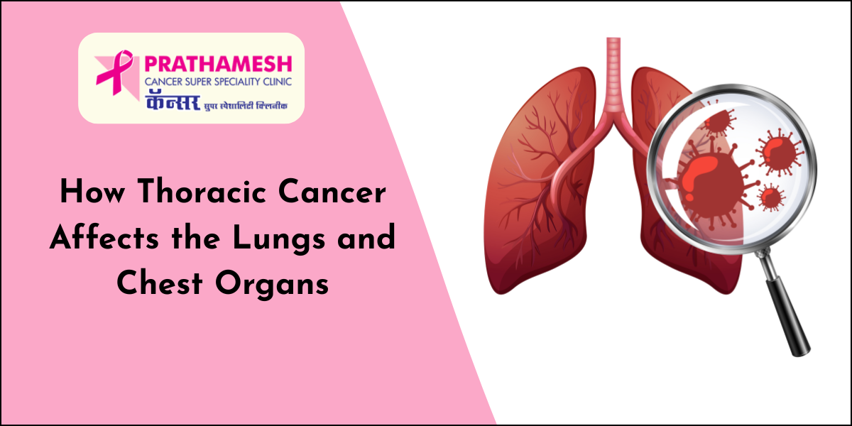 Thoracic Cancer